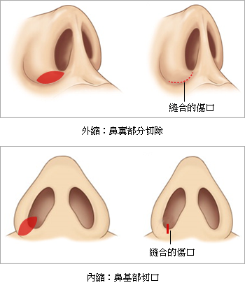 台中隆鼻