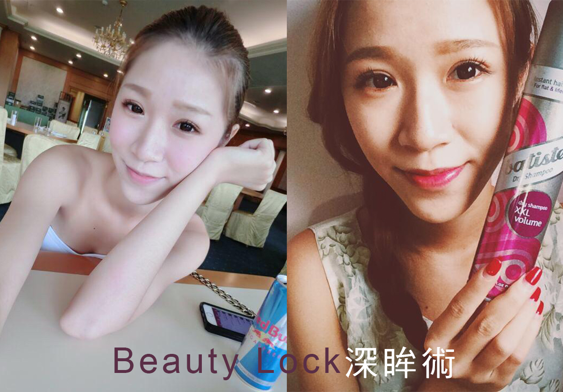 美麗線時尚診所案例分享「Beauty Lock深眸術，聶聶擺脫雙眼皮貼」