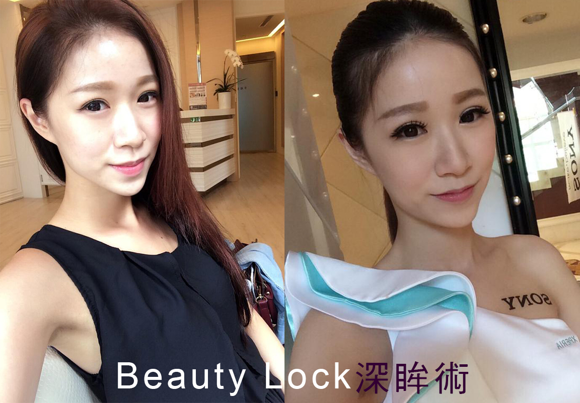 美麗線時尚診所案例分享「Beauty Lock深眸術，聶聶擺脫雙眼皮貼」