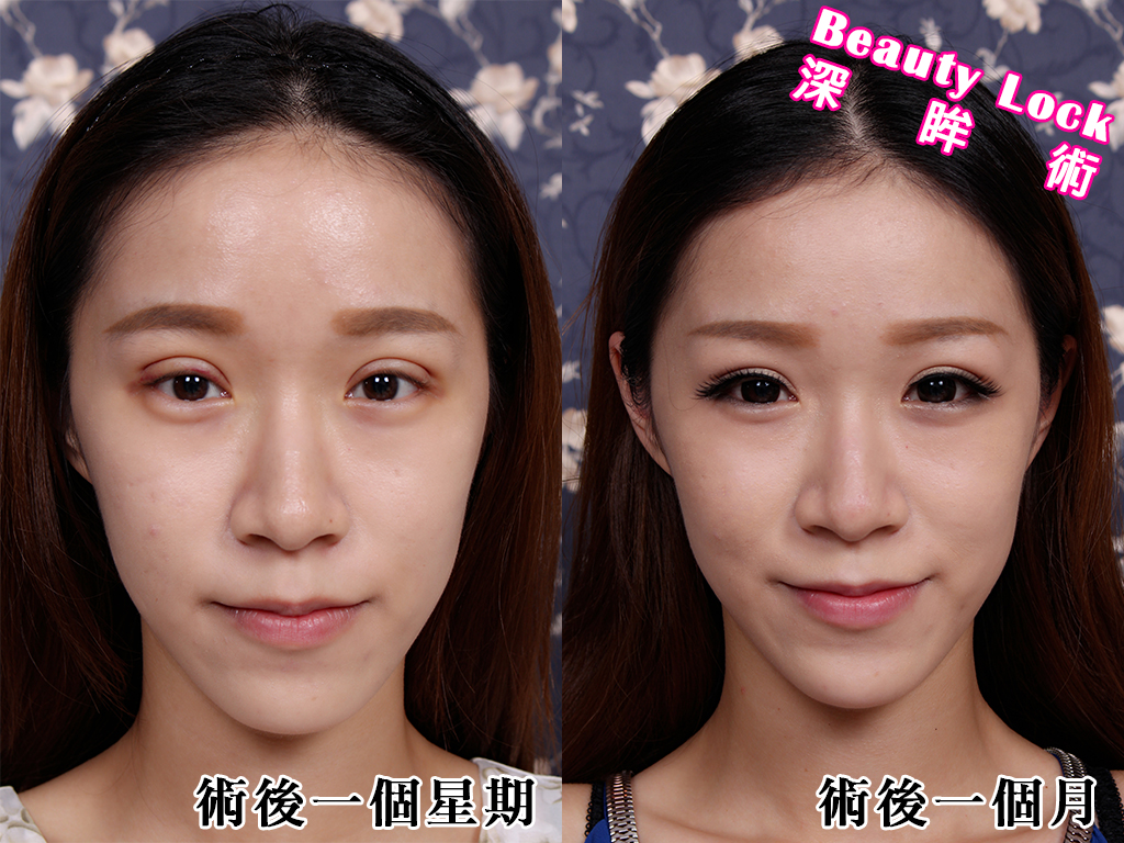 美麗線時尚診所案例分享「Beauty Lock深眸術，聶聶擺脫雙眼皮貼」