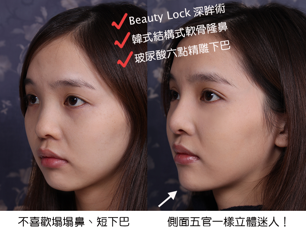 美麗線時尚診所案例分享「韓式軟骨隆鼻、BeautyLock深眸術雙眼皮、玻尿酸六點精雕下巴」