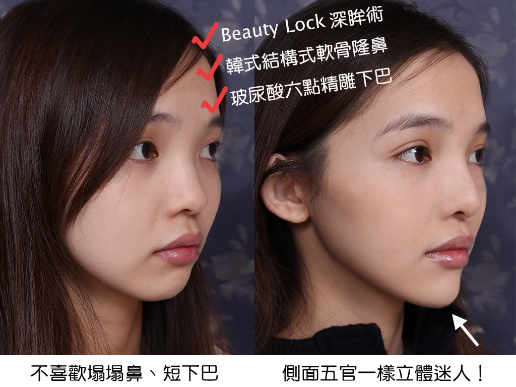 美麗線時尚診所案例分享「韓式軟骨隆鼻、BeautyLock深眸術雙眼皮、玻尿酸六點精雕下巴」