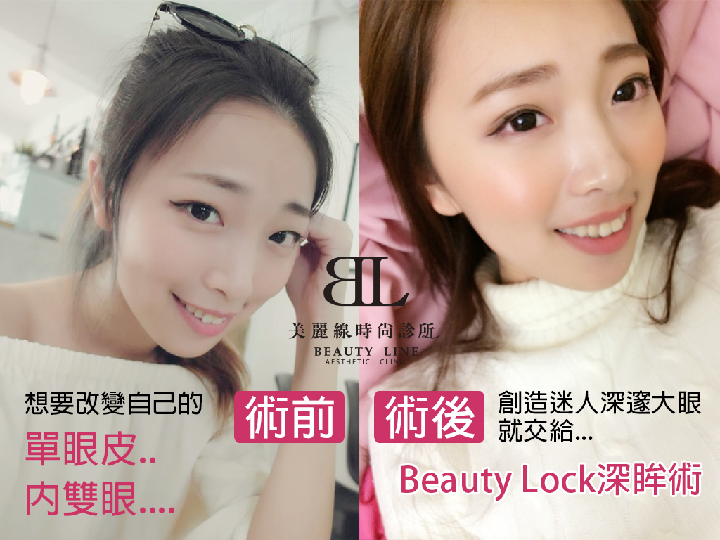 美丽线时尚诊所案例分享「BeautyLock深眸术，打造迷人魅力双眼皮」