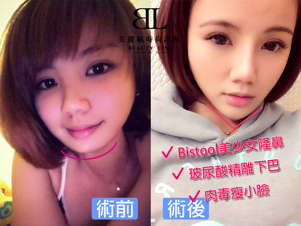 美麗線時尚診所案例「Bistool美少女隆鼻+玻尿酸精雕下巴+肉毒瘦小臉」