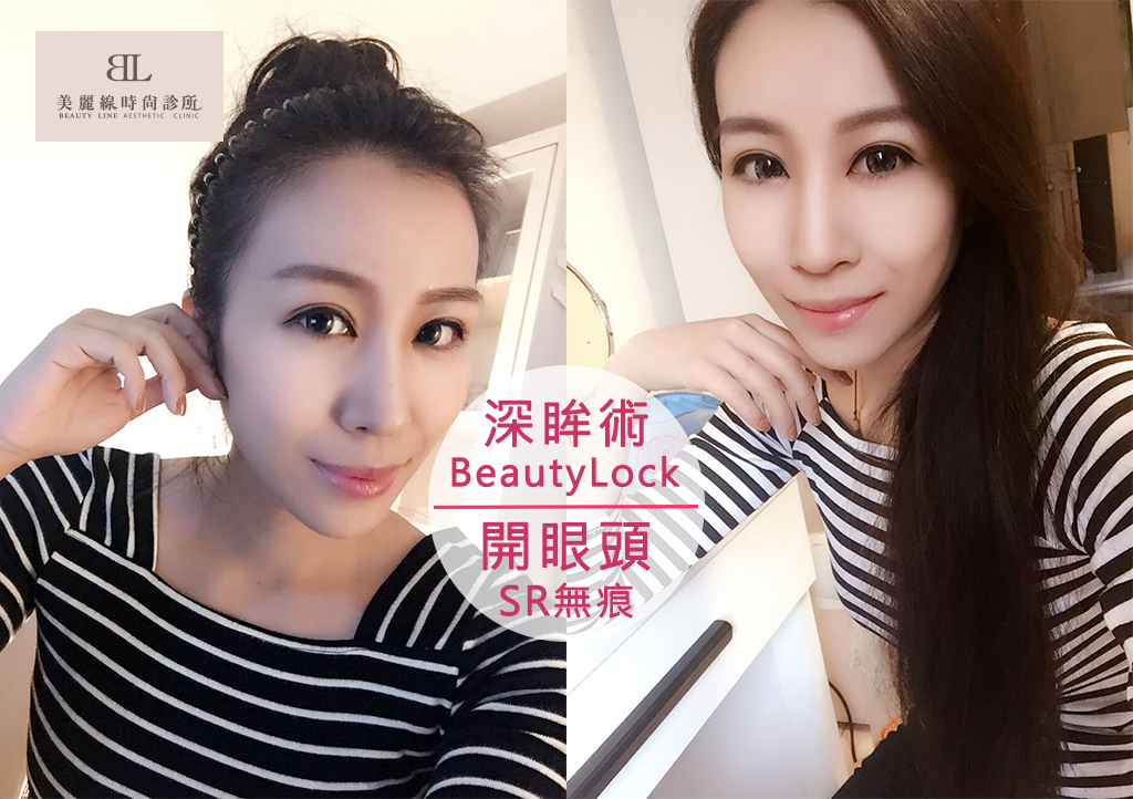 有了【BeautyLock深眸術+無痕開眼頭】掰掰囉～無神眼！