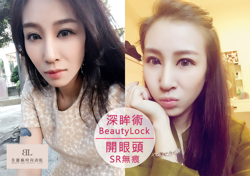 有了【BeautyLock深眸術+無痕開眼頭】掰掰囉～無神眼！