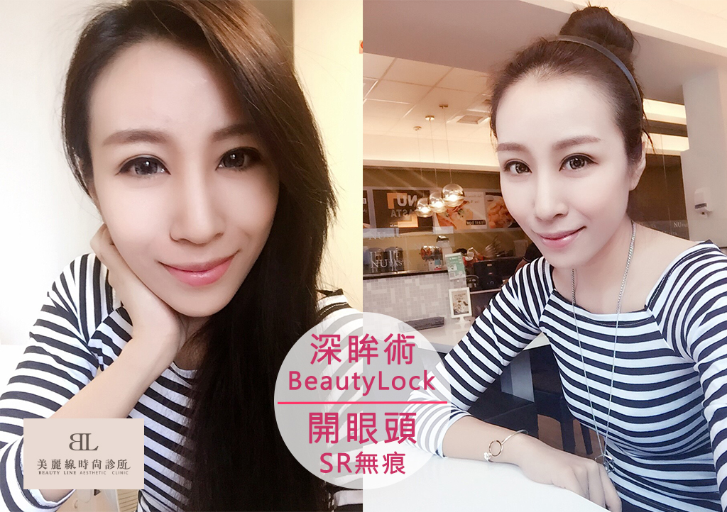 有了【BeautyLock深眸術+無痕開眼頭】掰掰囉～無神眼！