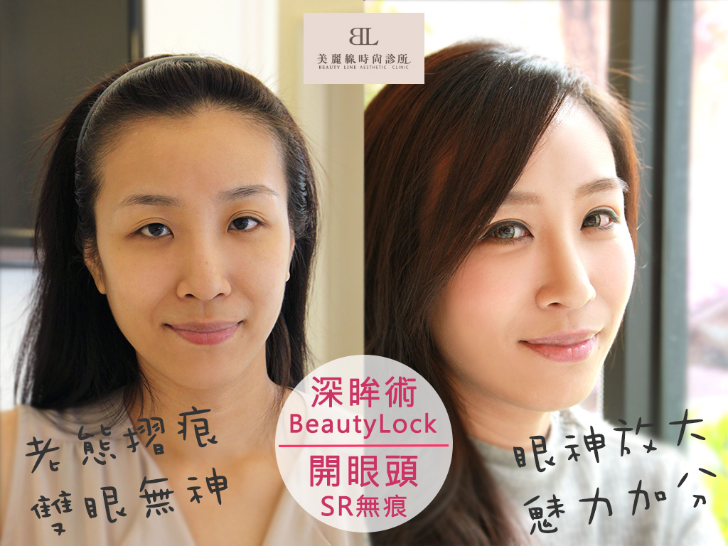 有了【BeautyLock深眸術+無痕開眼頭】掰掰囉～無神眼！