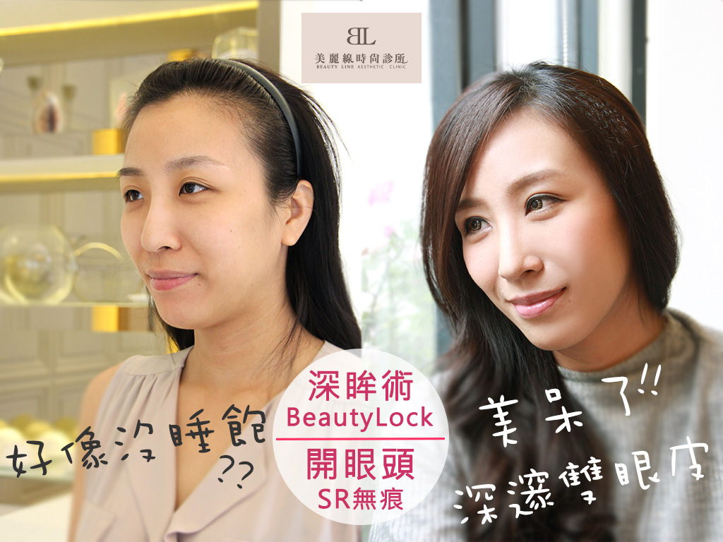 有了【BeautyLock深眸術+無痕開眼頭】掰掰囉～無神眼！